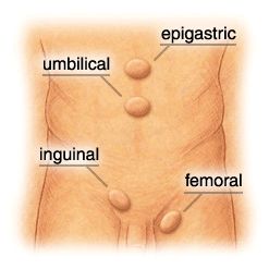 NOT ALL HERNIA TYPES SHOWN